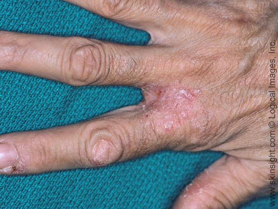 Dyshidrotic Eczema: Overview, Causes, Diagnosis & Pictures