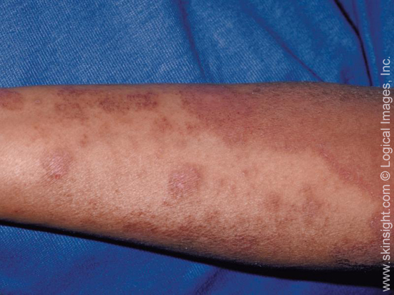 Itchy Skin Rash - Medical Pictures