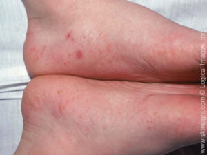 This image displays deep-appearing blisters typical of dyshidrotic eczema