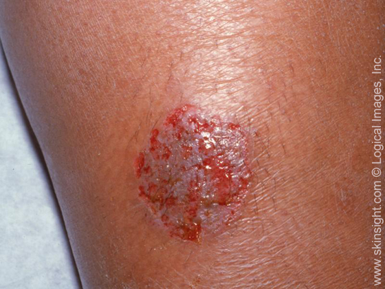 Fungal skin infections the facts | Health | Bupa UK