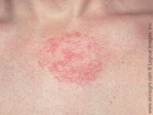 Seborrheic dermatitis can affect the upper chest and have round, red areas in addition to slight scaling.