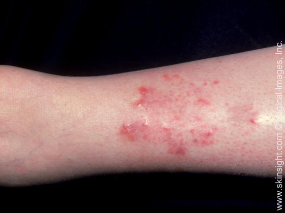 Itchy Brown Spots On Hands - Doctor insights on HealthTap