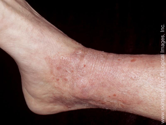 Pictures of Skin Rashes [Slideshow] - LoveToKnow