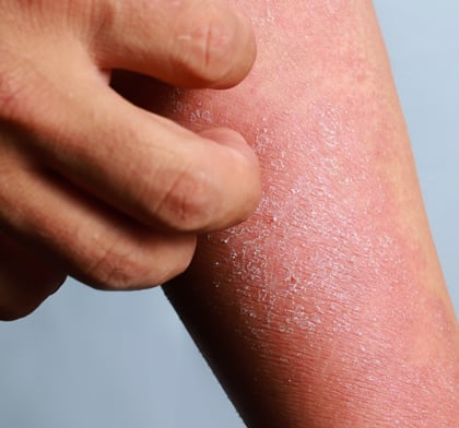 Hand itching dried skin on arm