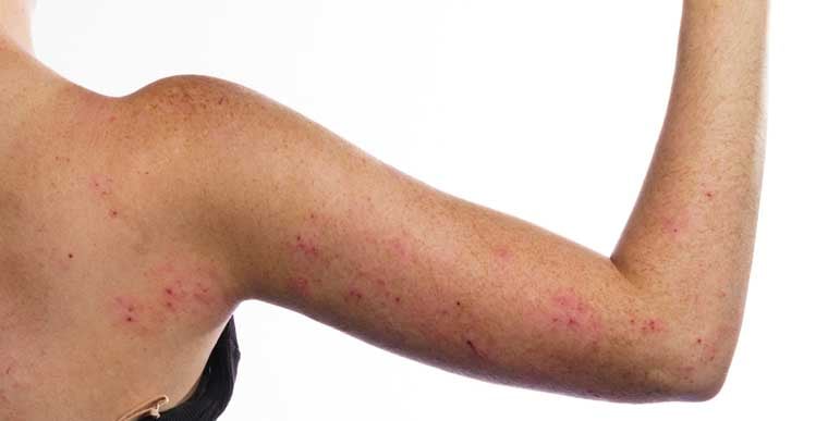 Red inflmaed patches of arm eczema on back of arm