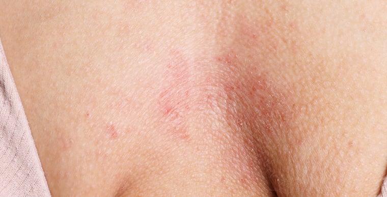Red inflamed patches of breast eczema