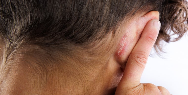 Dry patches of ear eczema on back of ear
