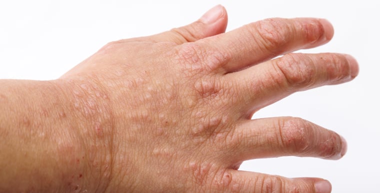 Patches of hand eczema on hand