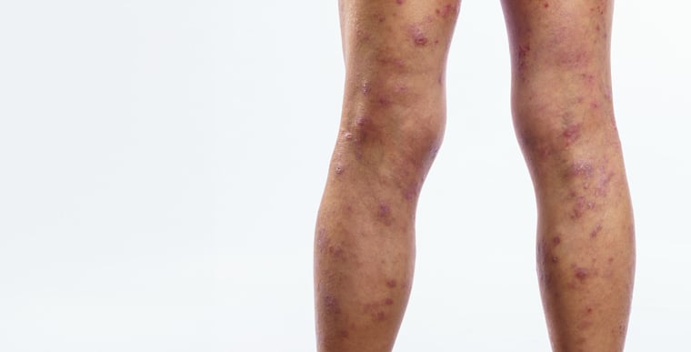 Patches of red inflamed leg eczema