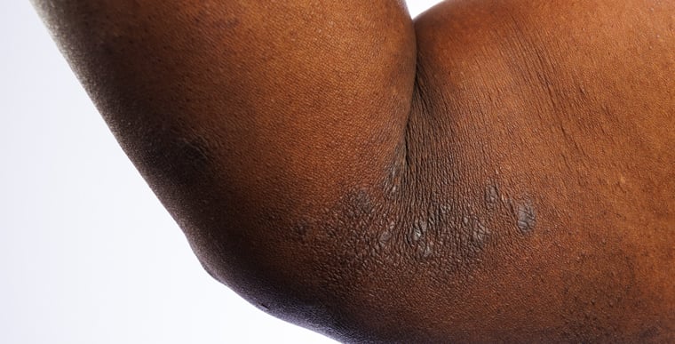 Patches of eczema on arm