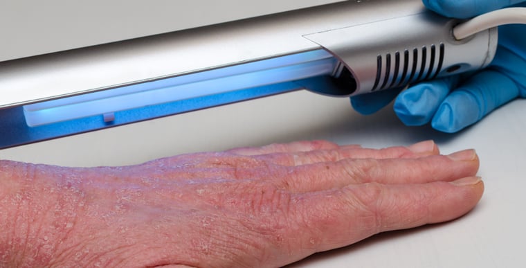 Inflamed hand being treated with phototherapy for eczema