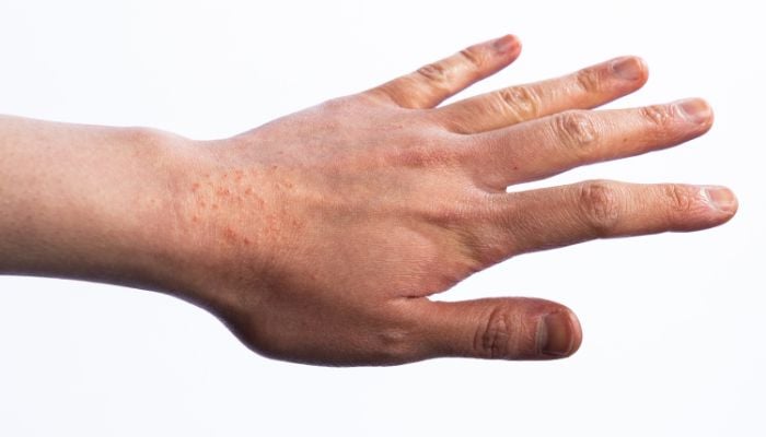 a hand with eczema rash