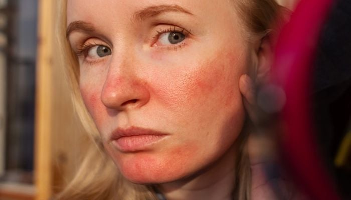 a woman with red skin on her face