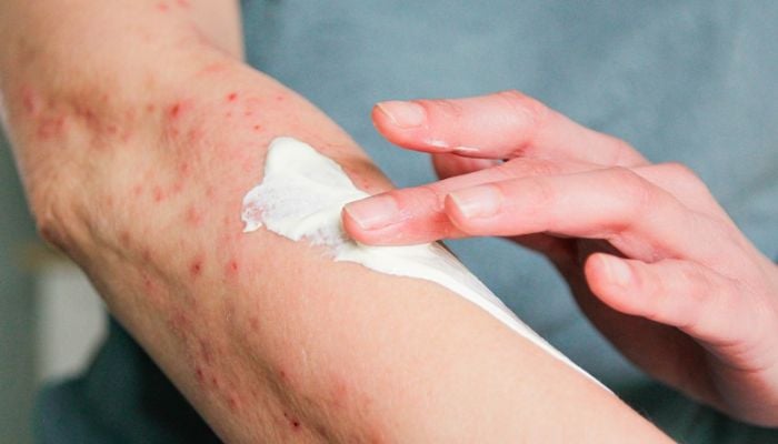 a person applies cream to an arm with a rash