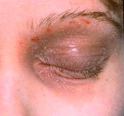 Image of inflamed patches on eyelid and face