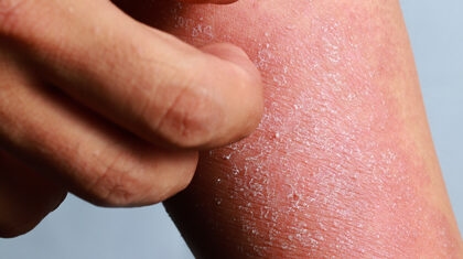 Hand itching dried skin on arm