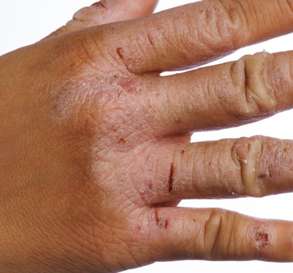 Image of inflamed knuckles on hand