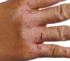 Image of inflamed knuckles on hand