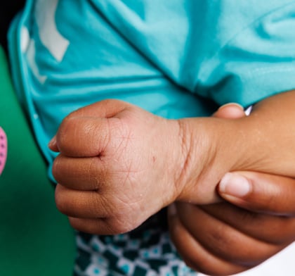 Inflamed skin on child's hand