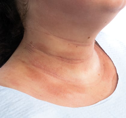 Inflamed patches on neck