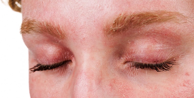 Red inflamed patches of eye eczema