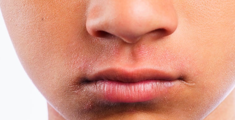 Close up picture of face eczema