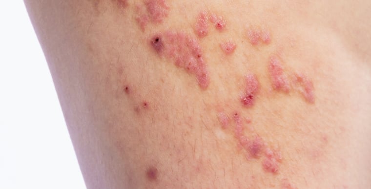 Eczema on skin
