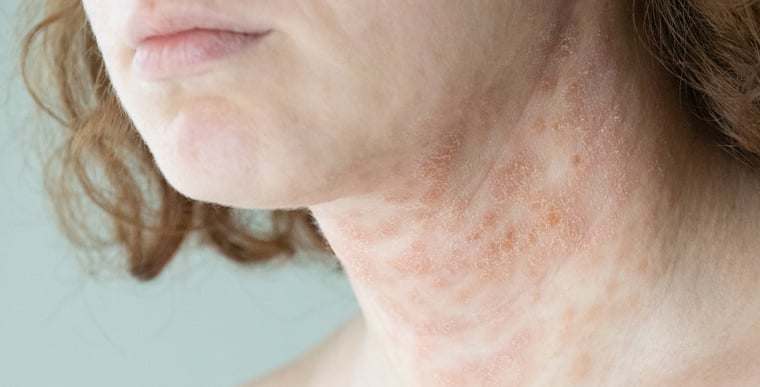 Red irritated skin on neck