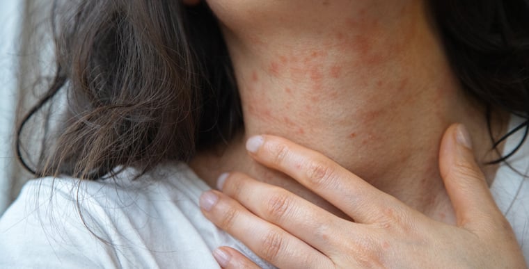 Woman touching irritated neck with hand
