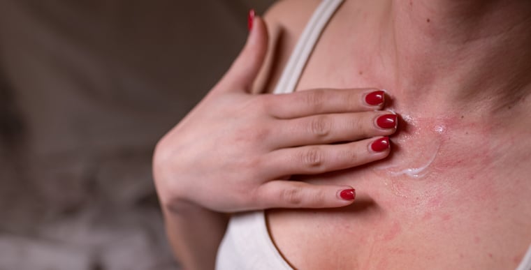 Woman applying lotion and moisturizers for eczema on chest