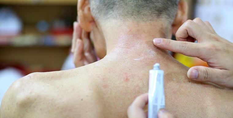 Topical steroid cream being applied to eczema on back of neck showing dangers of TSW