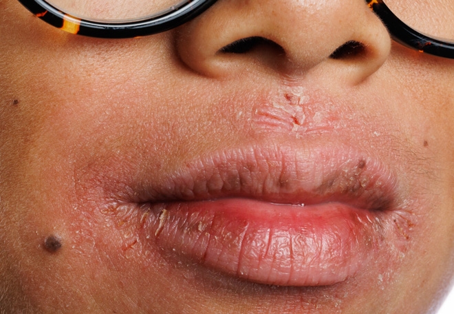 close-up of eczema on lips for eczema visual guide