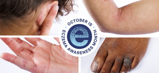 October is Eczema Awareness Month #UnhideEczema