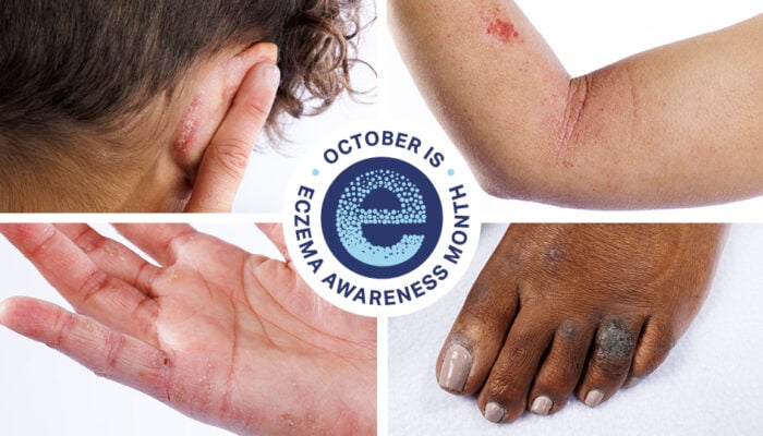 October is Eczema Awareness Month #UnhideEczema