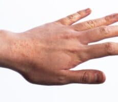a hand with eczema rash