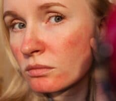 a woman with red skin on her face