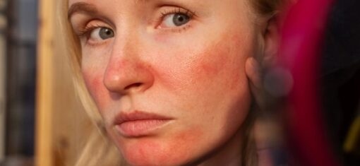 a woman with red skin on her face