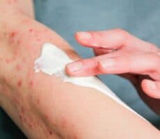 a person applies cream to an arm with a rash