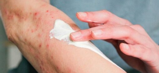 a person applies cream to an arm with a rash