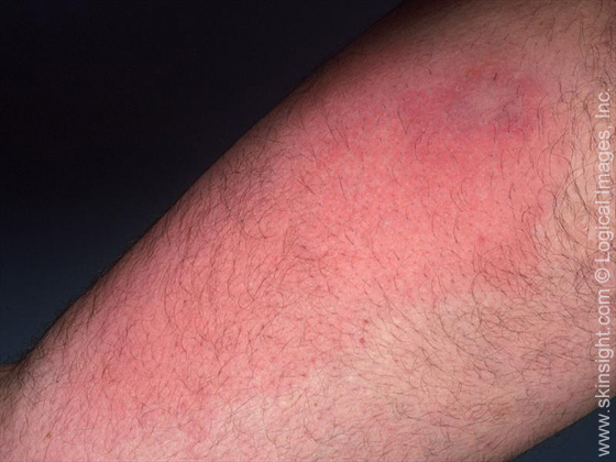 Eczema and Cellulitis | National Eczema Association