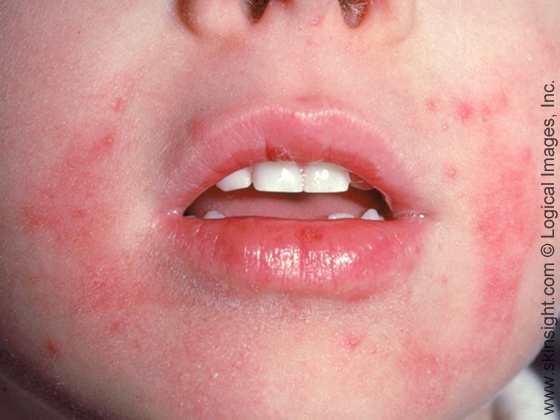 eczema in babies