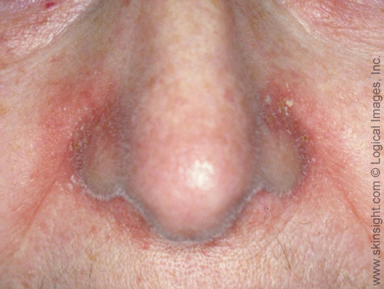 Forehead Rash (Skin Problems) Causes and Pictures ...