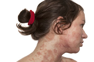 Atopic Dermatitis 101