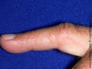 Dyshidrotic Eczema | Symptoms | Causes | Treatments | Pictures