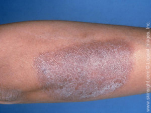 Dry Scaly Skin on Legs | LIVESTRONG.COM