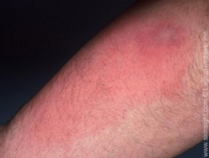 Early stage cellulitis on the arm