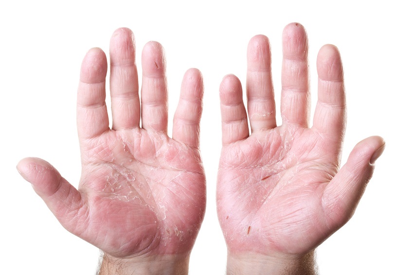 atopic dermatitis palms