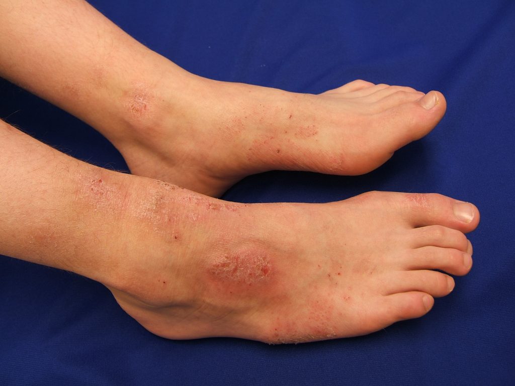 Dry Scaly Ankles