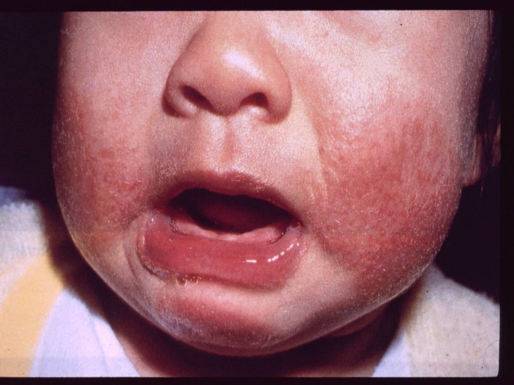 photo of eczema rash on a baby's face