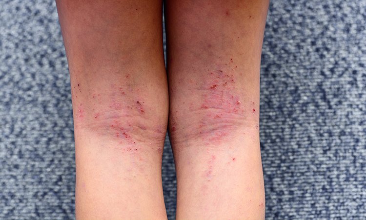 Atopic Dermatitis Symptoms And Causes National Eczema Association